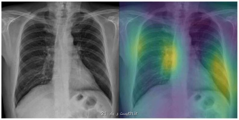 شناسایی سریع كووید-19 با كمك یك مدل مبتنی بر اشعه ایكس و هوش مصنوعی