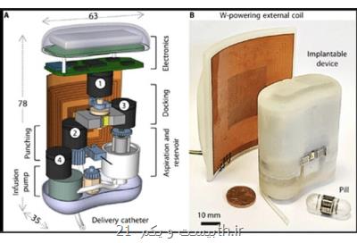 پمپ انسولین قابل ایمپلنت برای دیابتی ها