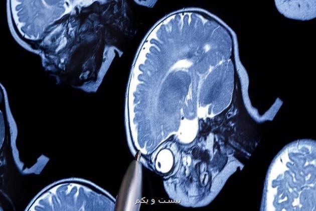 امکان تشخیص اوتیسم در کودکان ۲ ساله با بهره گیری از هوش مصنوعی