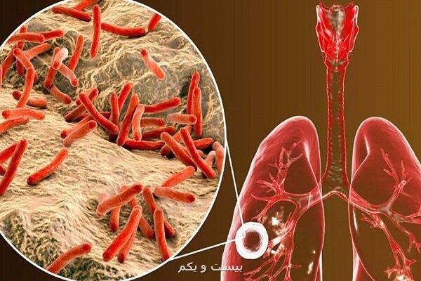 درمان سل با نانوذرات پرشده با آنتی بیوتیک!