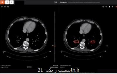 اقدامات مبتنی بر هوش مصنوعی پژوهشگران كشور برای مقابله با كرونا